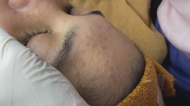 Терапия глубоких подкожных акне - SDS#195