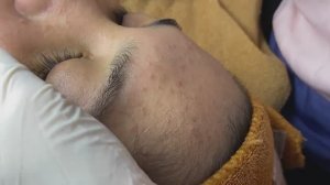 Терапия глубоких подкожных акне - SDS#195