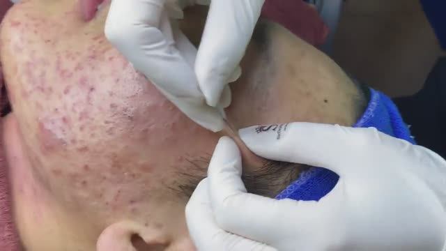 Лучшее выдавливание прыщей, часть 2 - SDS#182