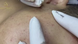 Loan Nguyen Acne Treatment 24tt