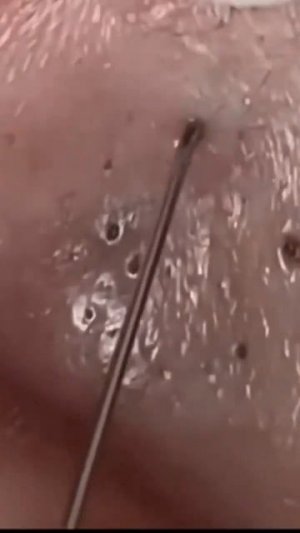 Чистка лица от угрей и акне. Выдавливание прыщей. Удаление черных точек и комедонов