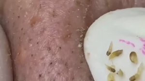 Профессиональное избавление от угревой сыпи и постакне #887624