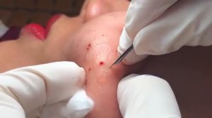 МНОГО прыщей — начинаем лечение