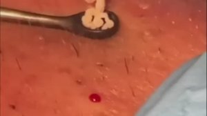 #42 Чистка лица от угрей и акне. Выдавливание прыщей. Удаление черных точек и комедонов