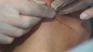 Процедура карбокситерапия в Москве. Борьба с целлюлитом. Карбокситерапия CO2 - как убрать морщины