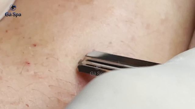 Глубокая чистка кожи от угрей у девушки. Часть 4 GA