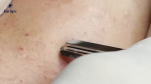 Глубокая чистка кожи от угрей у девушки. Часть 4 GA