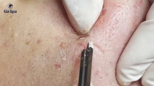 Глубокая чистка кожи от угрей у девушки. Часть 1 GA