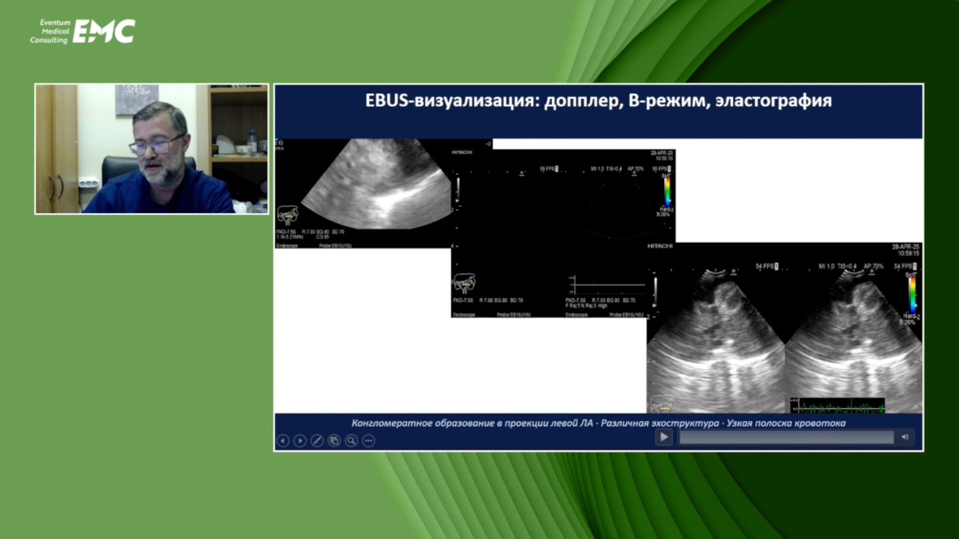 2 Васильев И.В, Маменко ИС. Использование EBUS у пациентов крайне высокого риска: серия наблюдений