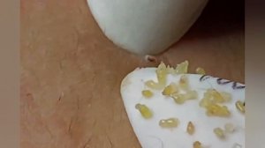 Выдавливание прыщей, угрей, черных точек и камедонов #266