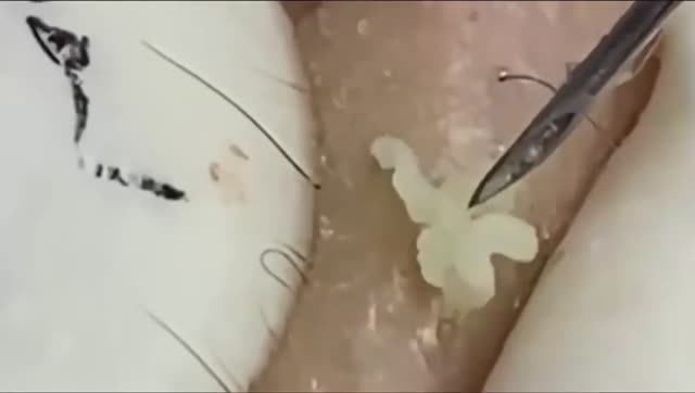 Лучшие моменты 2.Чистка лица от угрей и акне. Выдавливание прыщей. Удаление черных точек и комедонов