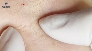 Глубокая чистка кожи от угрей у девушки. Часть 3 GA