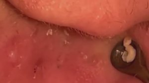 #44 Чистка лица от угрей и акне. Выдавливание прыщей. Удаление черных точек и комедонов