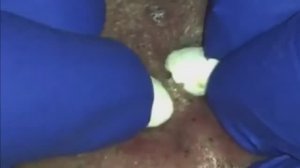 #56 Чистка лица от угрей и акне. Выдавливание прыщей. Удаление черных точек и комедонов