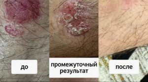 Псориаз. Результат за 8 сеансов.