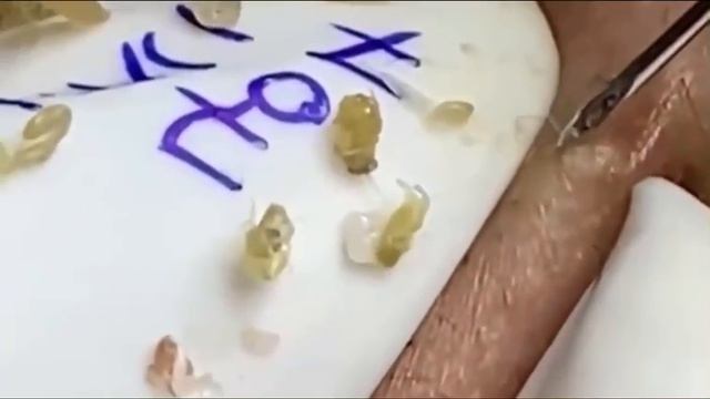 Лучшие моменты.Чистка лица от угрей и акне. Выдавливание прыщей. Удаление черных точек и комедонов