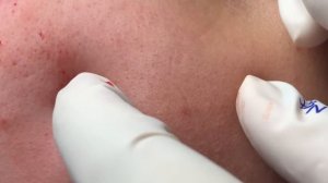 ТАЙНА ПОД КОЖЕЙ: с виду ничего, а на самом деле — море акне