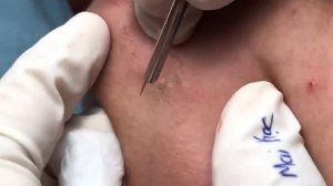 Подкожные акне и комедоны. Чистка