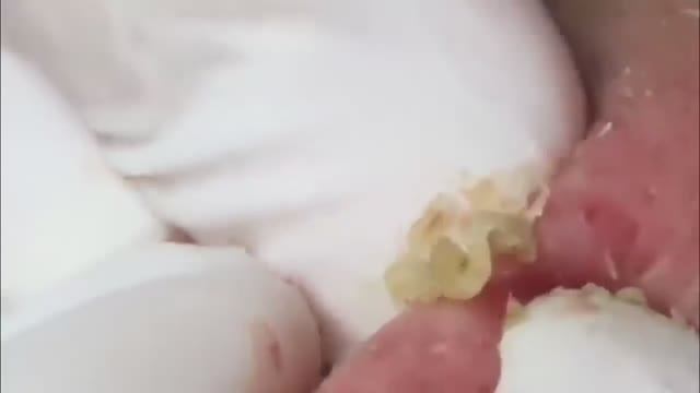 #9 Чистка лица от угрей и акне. Выдавливание прыщей. Удаление черных точек и комедонов