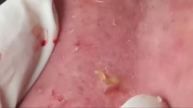 #10 Чистка лица от угрей и акне. Выдавливание прыщей. Удаление черных точек и комедонов