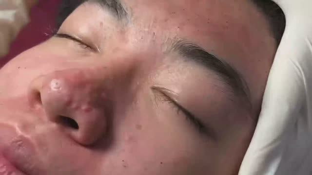 Лечение акне: работаем с самыми необычными комедонами