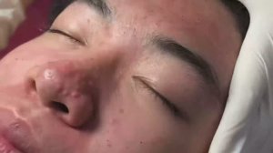 Лечение акне: работаем с самыми необычными комедонами