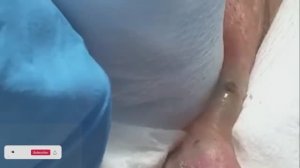 #12 Чистка лица от угрей и акне. Выдавливание прыщей. Удаление черных точек и комедонов