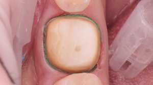 Препарирование зуба 46