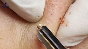 Глубокая чистка кожи от угрей у девушки. Часть 2 GA