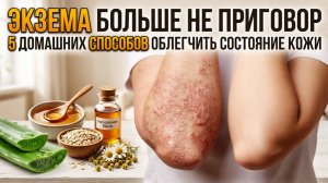 Экзема больше не приговор: 5 домашних способов облегчить состояние кожи