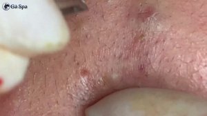 Чистка лица от акне #чисткалица #механическаячистка #удалениечерныхточек