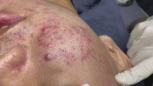 010 • Relax Spa • АСМР • Acne collection