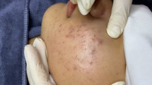 ЛЕЧЕНИЕ АКНЕ удовлетворение и релакс в одном флаконе