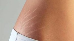 Жизнь с диабетом. Растяжки на коже эндокринное заболевание.