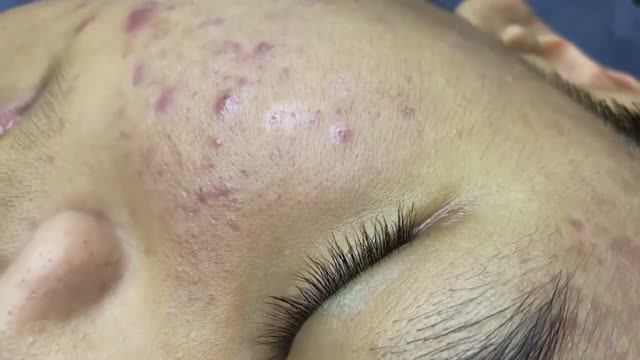 015 • Relax Spa • АСМР • Acne collection