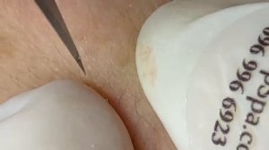 Выдавливание прыщей, угрей, черных точек и камедонов #271