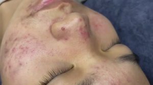 018 • Relax Spa • АСМР • Acne collection