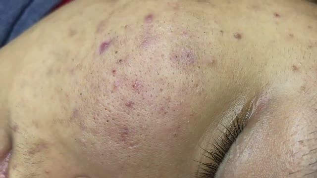 020 • Relax Spa • АСМР • Acne collection