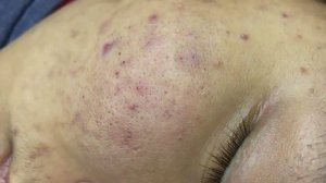 020 • Relax Spa • АСМР • Acne collection