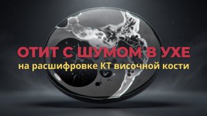 ШУМ В УХЕ при среднем ОТИТЕ и МАСТОИДИТЕ с жидкостью в ухе на РАСШИФРОВКЕ КТ височных костей