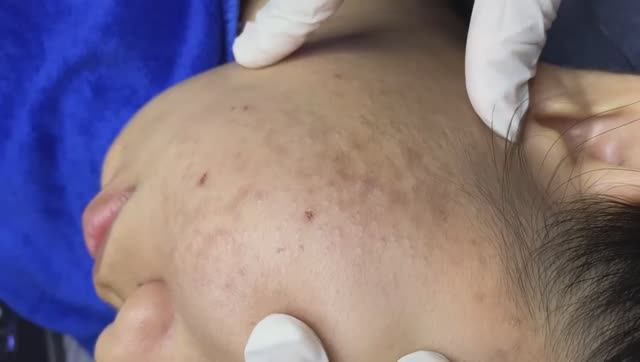 017 • Relax Spa • АСМР • Acne collection