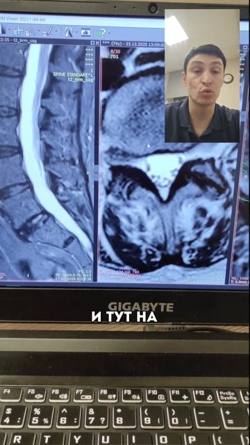 Нарушение паттерна ходьбы из-за слабости тазобедренного сустава.