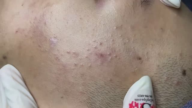 016 • Relax Spa • АСМР • Acne collection