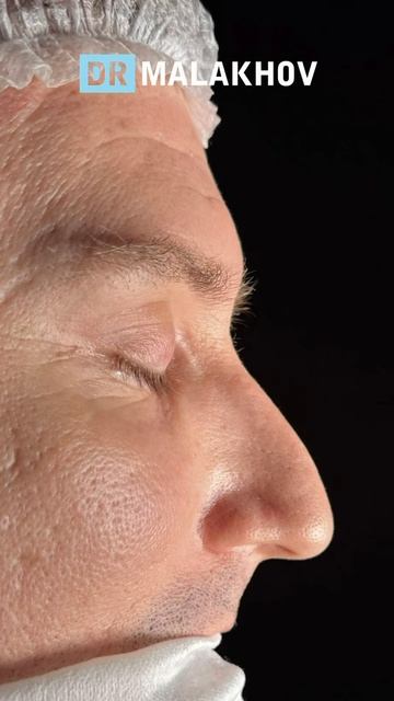 Мужская риносептопластика 🔥 ДО/ПОСЛЕ на операционном столе.