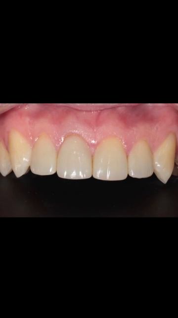 Внутрикоронковое отбеливание: Как спасти потемневший передний зуб