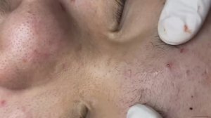 007 • Relax Spa • АСМР • Acne collection