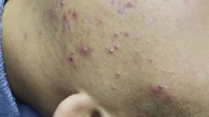 014 • Relax Spa • АСМР • Acne collection