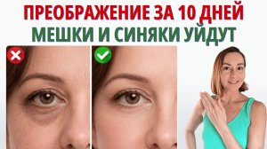 Как убрать мешки грыжи синяки под глазами без уколов: 5 минут в день