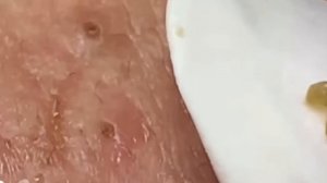 #175 Чистка лица от угрей и акне. Выдавливание прыщей. Удаление черных точек и комедонов