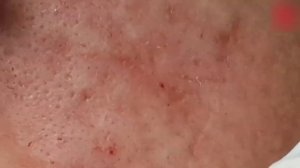 Лечение скрытых прыщей (закрытых комедонов) HHV